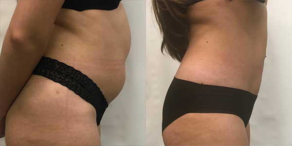 Liposuction Harley Street