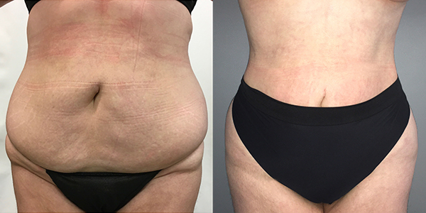 Liposuction