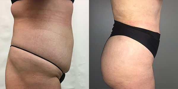 London Liposuction