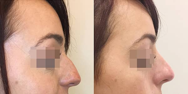 Non-Surgical Rhinoplasty