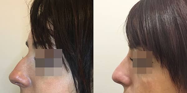 Non-Surgical Rhinoplasty