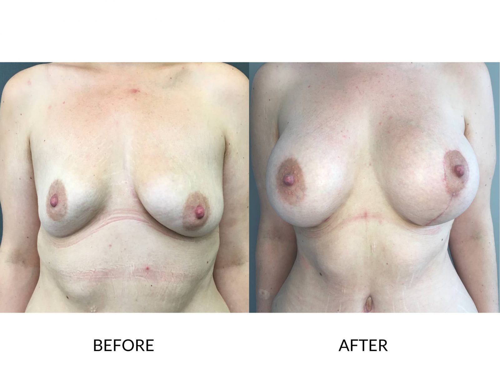 Breast Lift London Plastic Surgery