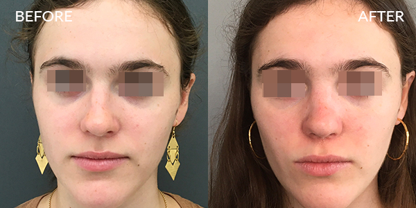 Rhinoplasty London