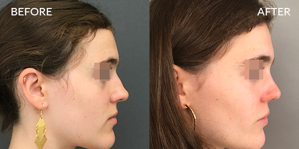 Rhinoplasty London