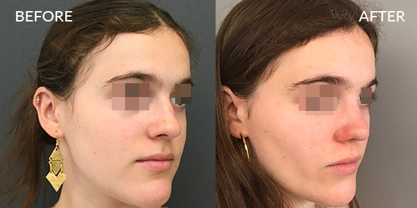 Rhinoplasty London