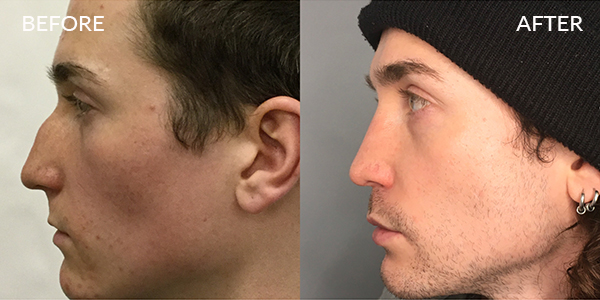 Rhinoplasty London