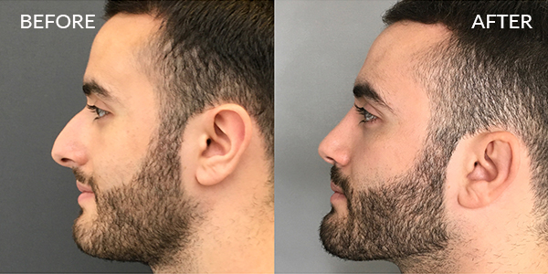 Rhinoplasty London