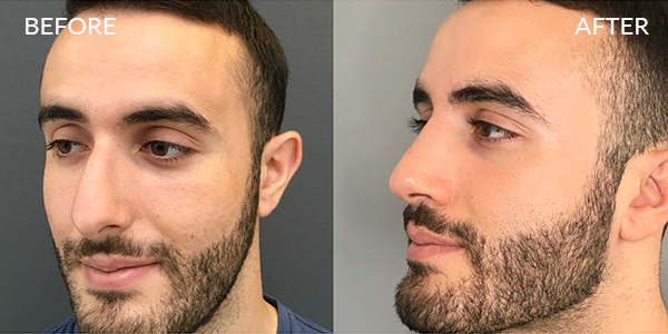 Rhinoplasty London