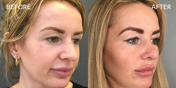 Rhinoplasty London