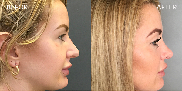 Rhinoplasty London