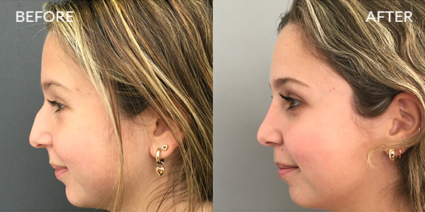 Rhinoplasty London