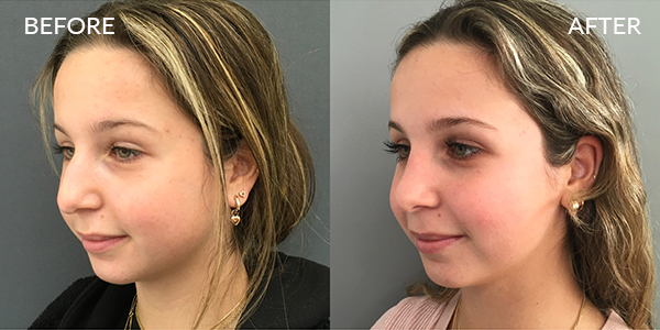 Rhinoplasty London