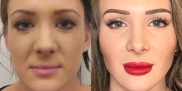 Rhinoplasty London