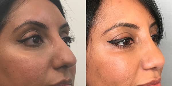 Rhinoplasty London