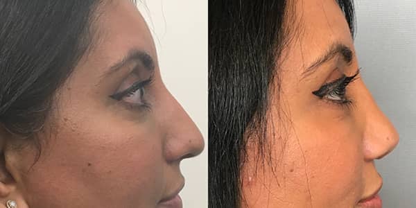 Rhinoplasty London