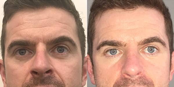 Male Rhinoplasty London