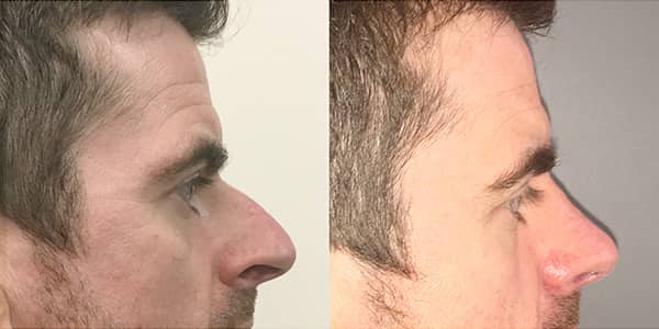 Male Rhinoplasty London