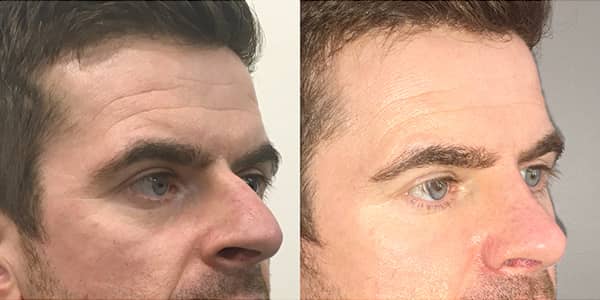 Male Rhinoplasty London