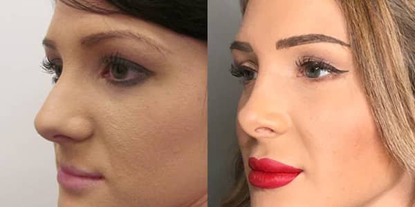 Rhinoplasty London