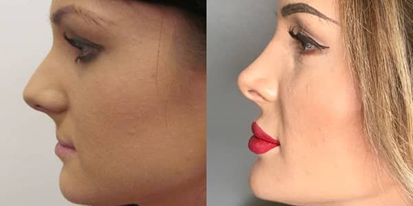 Rhinoplasty London