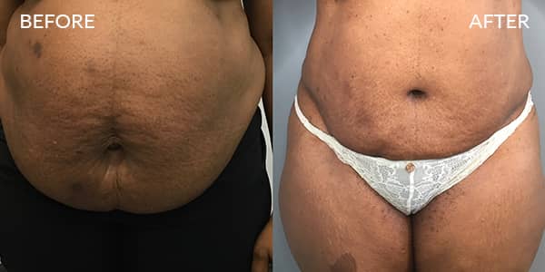 Tummy Tuck and Liposuction London