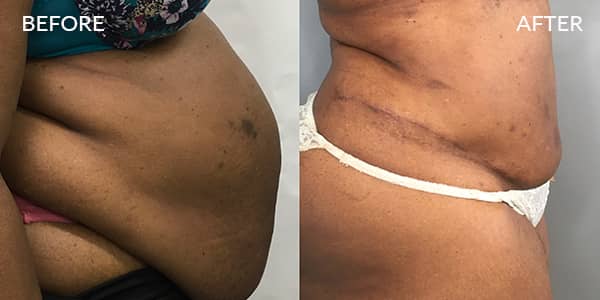 Tummy Tuck and Liposuction London