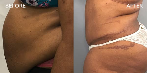 Tummy Tuck and Liposuction London