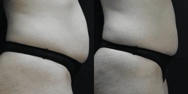 Accent Ultrasound Skin Tightening Before & After