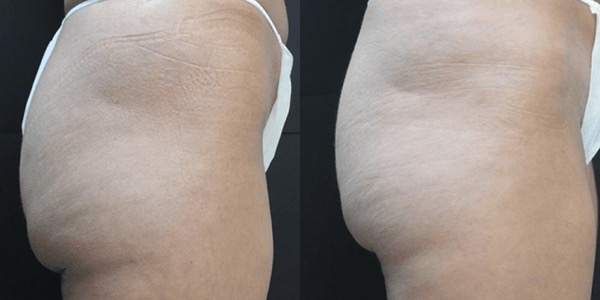 Accent Ultrasound Skin Tightening Before & After