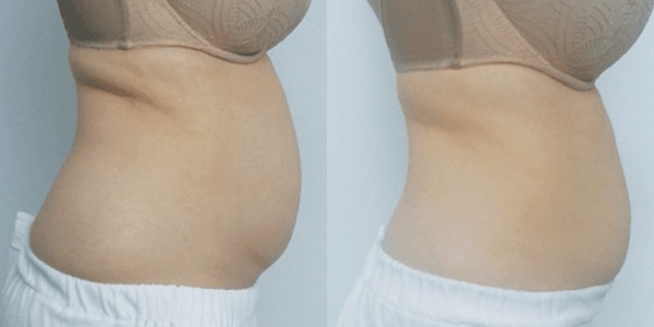 Accent Ultrasound Skin Tightening Before & After