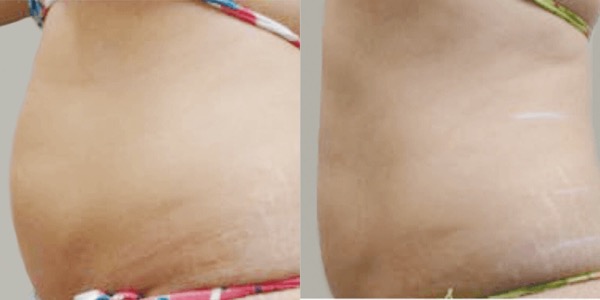 Accent Ultrasound Skin Tightening Before & After