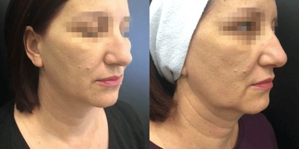 Accent Radiofrequency Before & After