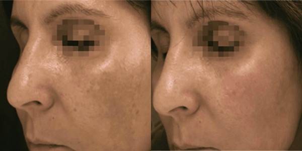 Accent Radiofrequency Before & After