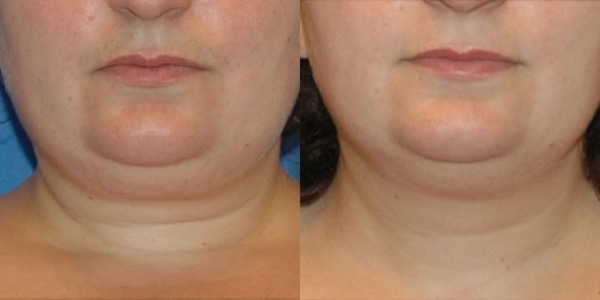 Accent Radiofrequency Before & After