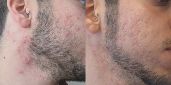 ClearSkin Acne Treatment Before & After