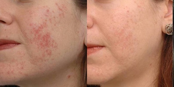 ClearSkin Acne Treatment Before & After