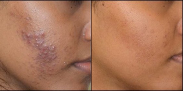 ClearSkin Acne Treatment Before & After