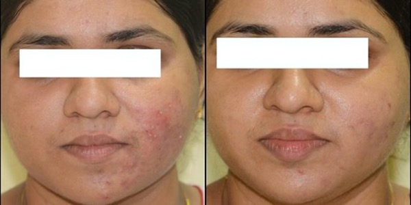 Isolaz Acne Treatment Before & After
