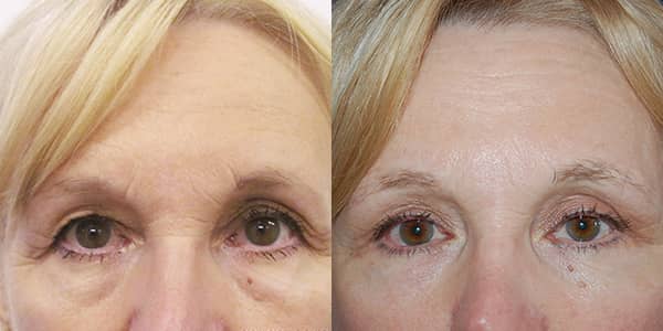 Blepharoplasty London 111 Harley St.