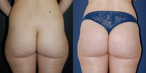 Brazilian Butt Lift Before & After