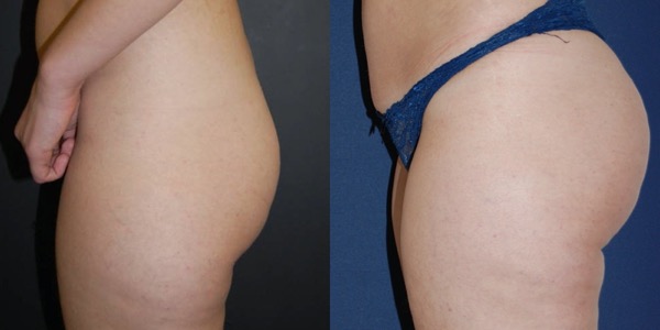 Brazilian Butt Lift Before & After