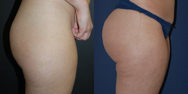 Brazilian Butt Lift Before & After