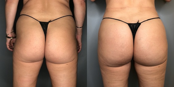 Brazilian Butt Lift Before & After