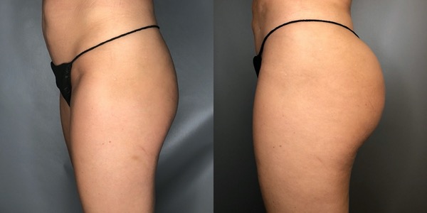 Brazilian Butt Lift Before & After