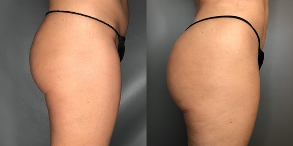 Brazilian Butt Lift Before & After