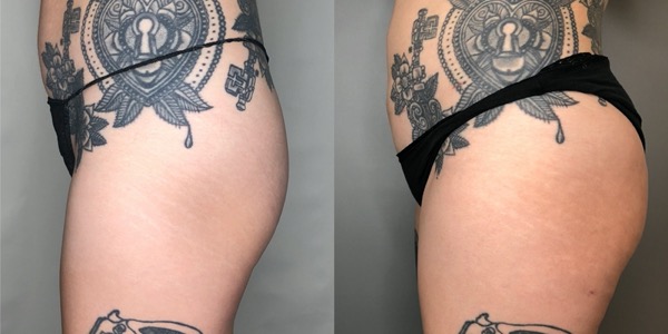 Brazilian Butt Lift Before & After