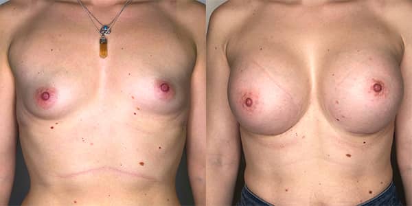 Breast Enlargement 111 Harley St.