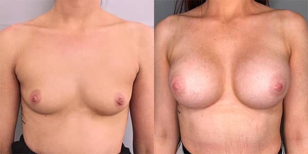 Breast Enlargement 111 Harley St.