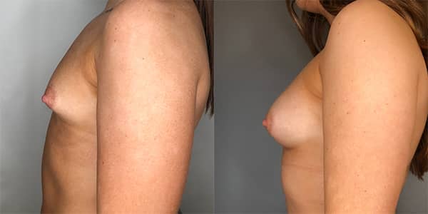 Breast Enlargement 111 Harley St.