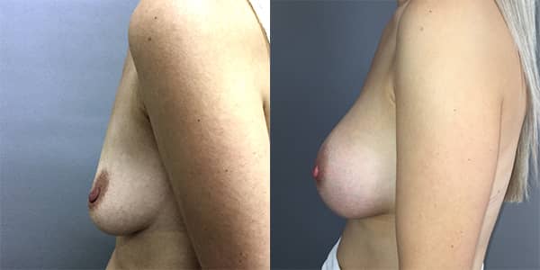 Breast Enlargement 111 Harley St.